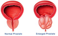 prostate 1